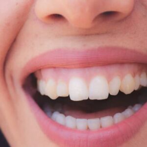 Las sonrisas que muestran demasiada encía no suponen problemas para la salud bucodental, pero sí pueden afectar a la autoestima