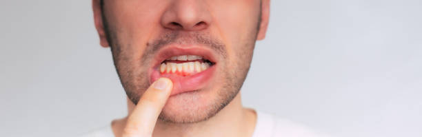 Tratamiento periodontal: en busca del hueso perdido
