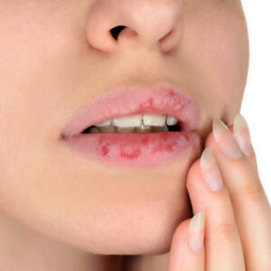 Sequedad bucal, aparición de caries, halitosis y problemas de alineación dental, principales efectos de respirar por la boca